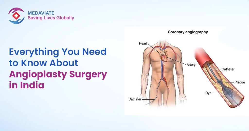 Angioplasty Surgery in India